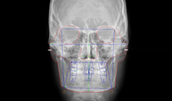 Análise Cefalométrica