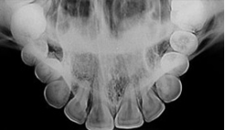 Radiografia oclusal