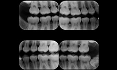 Radiografia interproximal