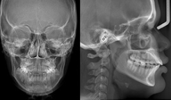 Telerradiografia lateral e frontal