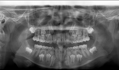 Radiografia Panorâmica