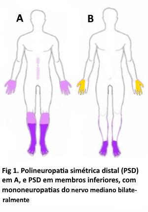 Polineuropatia: Diabetes Mellitus