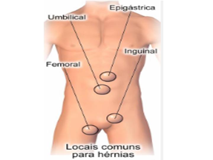 Hérnias da Parede Abdominal