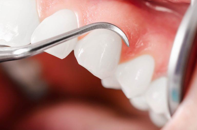 Estética Dental: Conheça os 7 tratamentos mais realizados atualmente