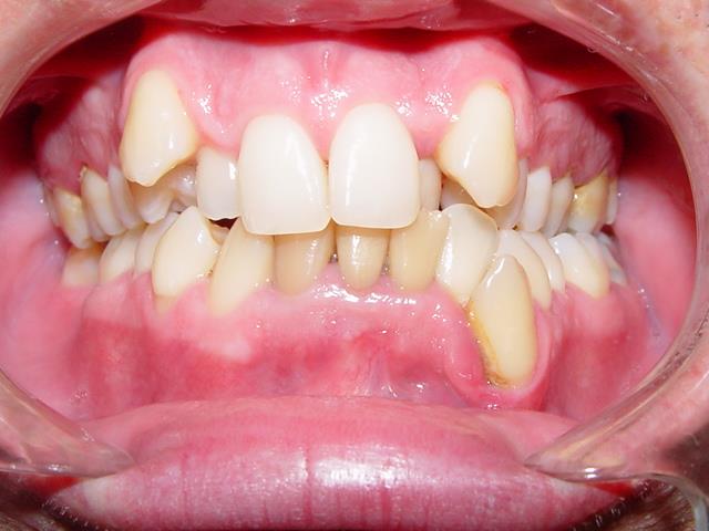 Qual a idade ideal para colocar aparelho dentário?