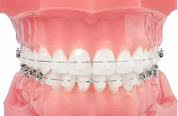 Aparelho Autoligado Damon VS. Aparelho Invisalign