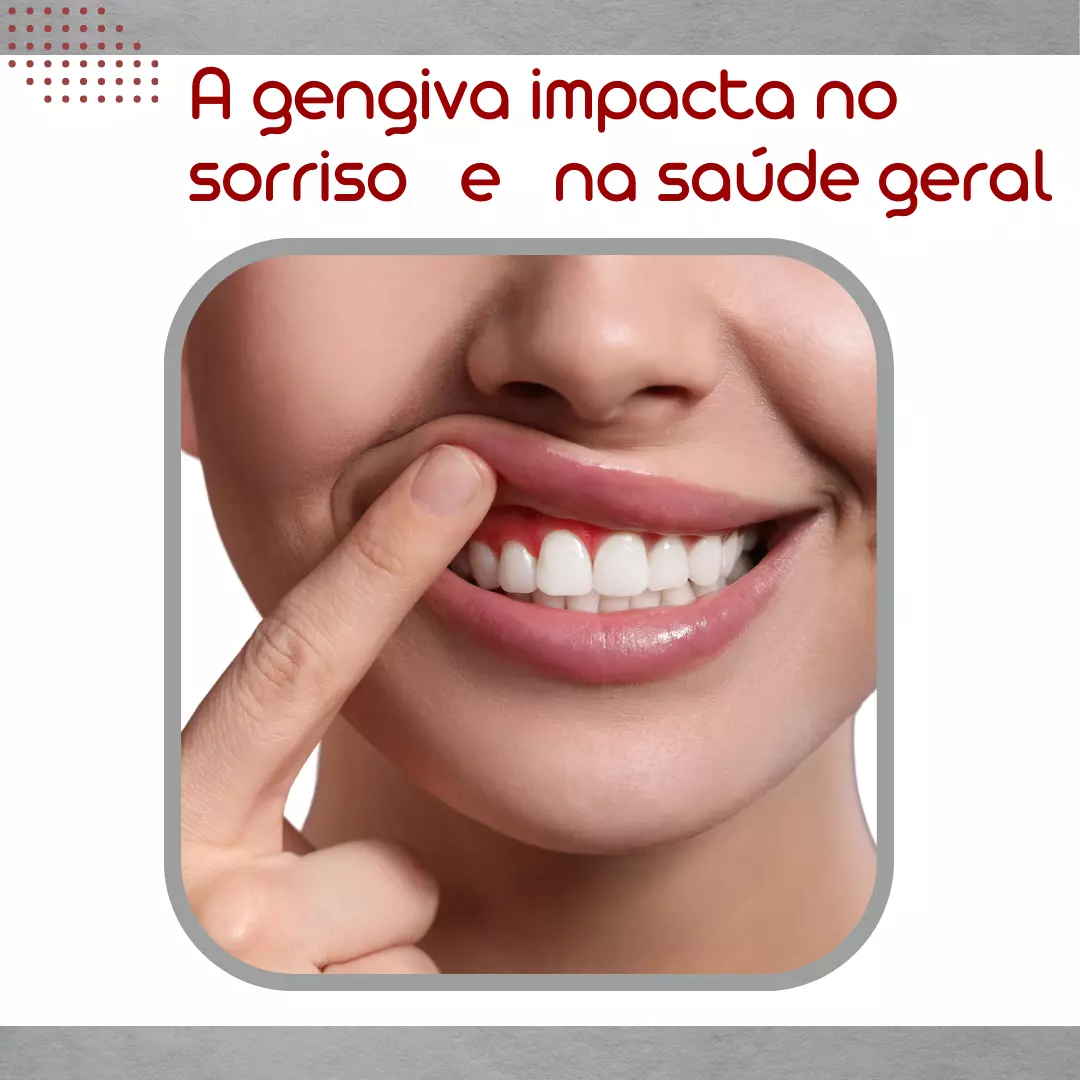 PERIODONTIA - GENGIVOPLASTIA - PEELING GENGIVAL - HALITOSE